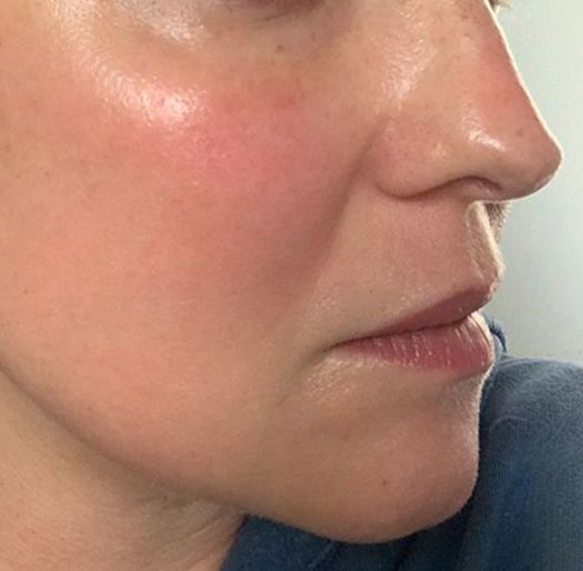 Intense Brightening Burst Serum Results